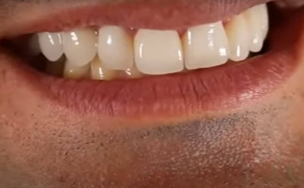 faccette dentali