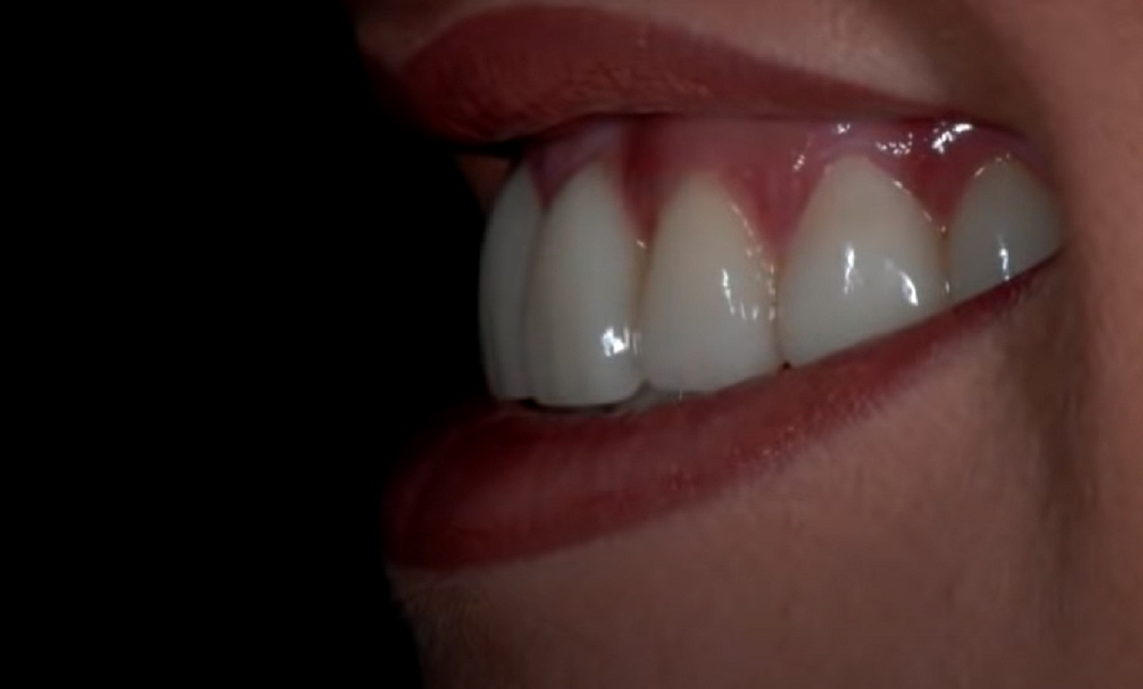 faccette denti